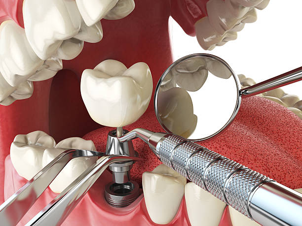 Best Dental Abscess Treatment in Mcnary, AZ